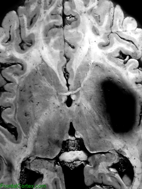 Intraparenchymal hemorrhage, horizontal section of brain